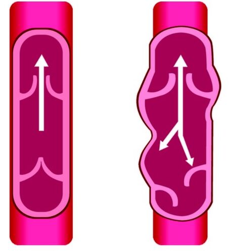 Venas Pathologie