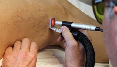 Laserbehandlung von Krampfadern