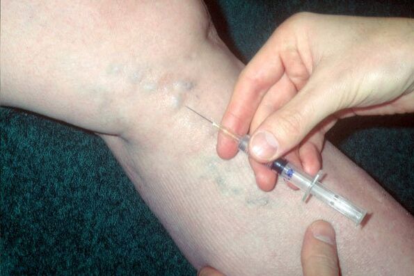 Sklerotherapie bei Krampfadern