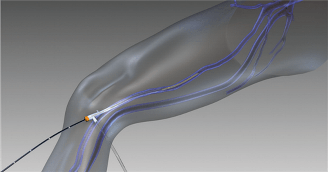 Radiofrequenz-Obliteration bei Krampfadern