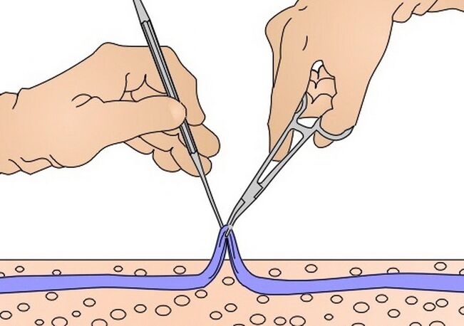 Venenentfernung bei Krampfadern