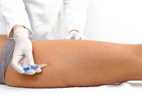 Sklerotherapie als Methode zur Behandlung von Krampfadern.